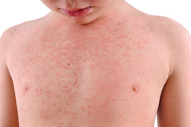 Recurso pediatria exantema granitos